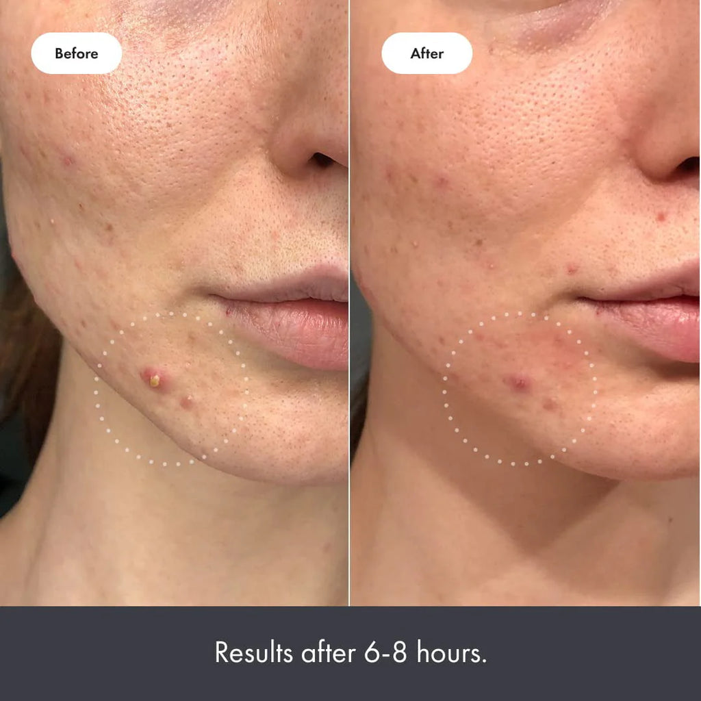 Hydrocolloid Acne Pimple Patches (27 Patches) M37572